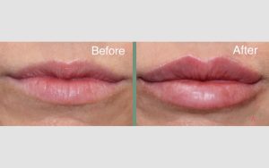 Lip Contouring by Dr. Irene